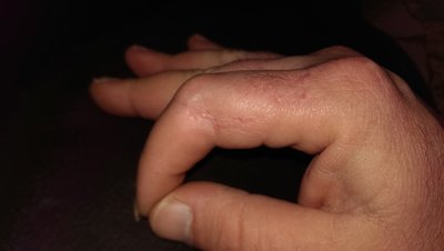 MY finger as it now , 15 years after my accident.